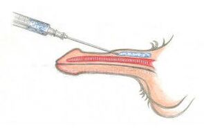 Injizieren Sie Hyaluronsäure unter die Haut, um den Penis dicker zu machen