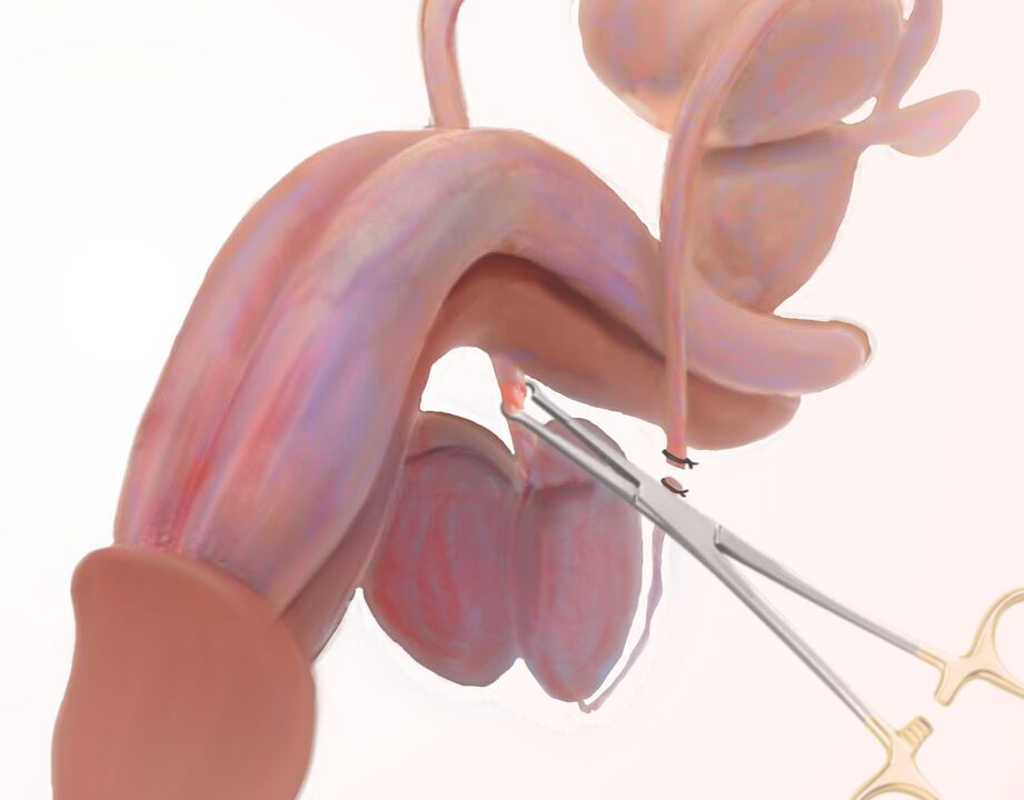 Ligamentotomie zur Penisvergrößerung