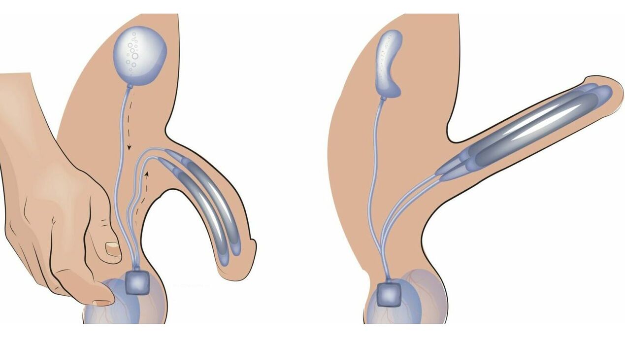 Penisprothese zur Penisvergrößerung